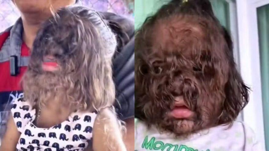 Alerta : 11 crianças adquirem “síndrome do lobisomem” após contato com loção para calvície