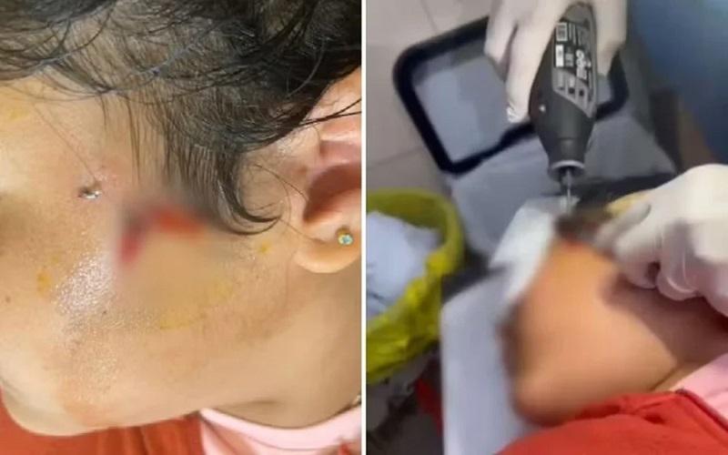 Criança fica com anzol preso ao rosto durante pescaria